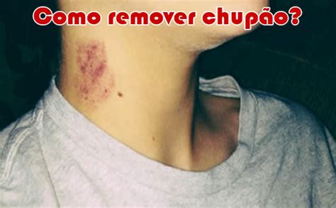 Como Remover um Chupão: 13 Passos (com Imagens)